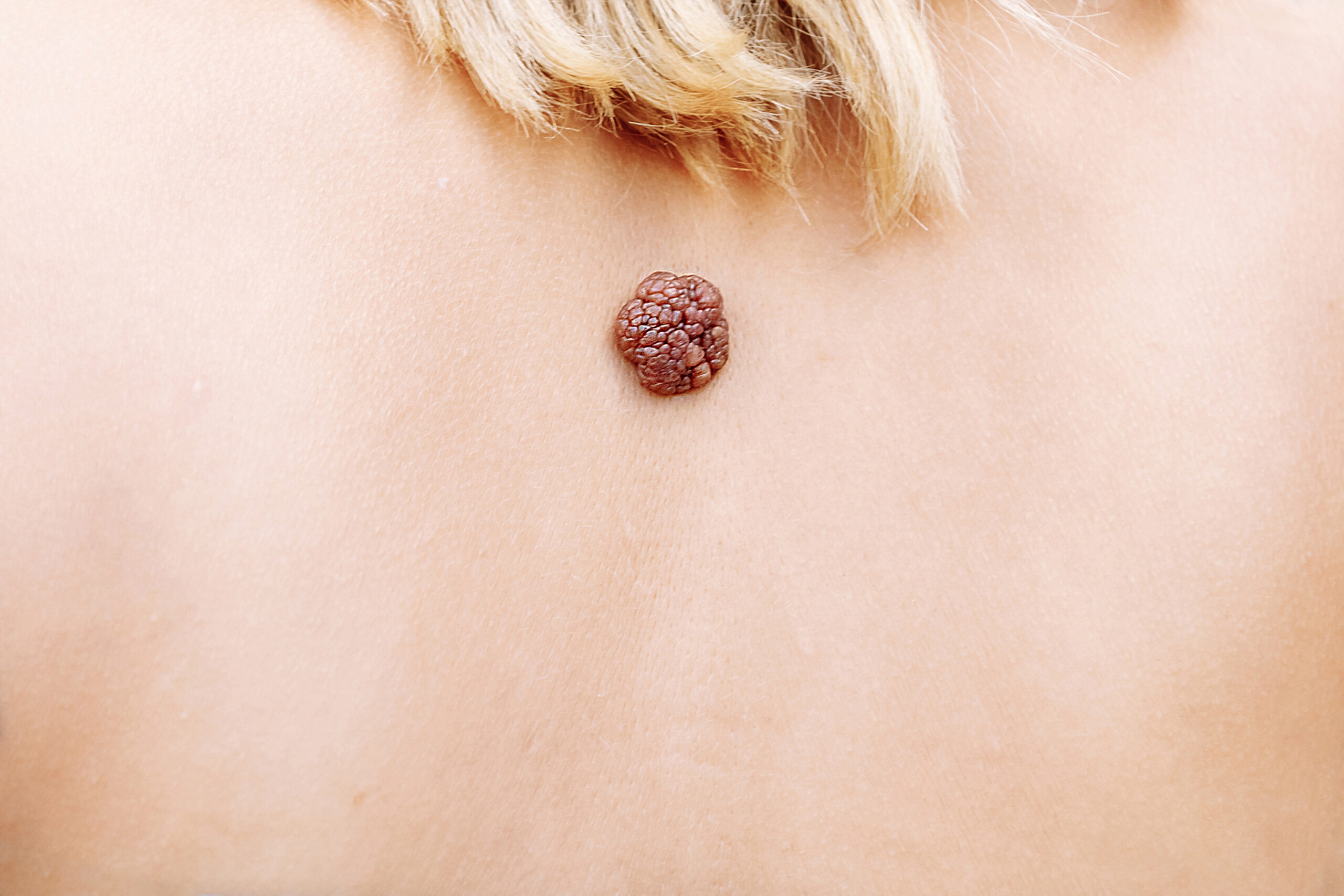 ¿De qué se alimenta un tumor canceroso?